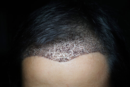FUE hair transplant in dark environment