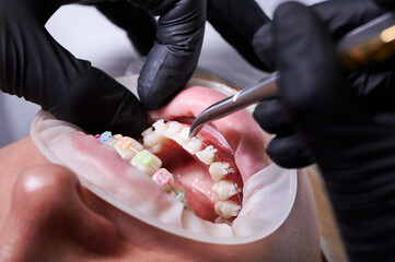 Close-up snapshot of dentist's hands in black gloves making dental procedure, process of attaching...