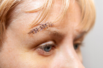 medical suture on a woman face