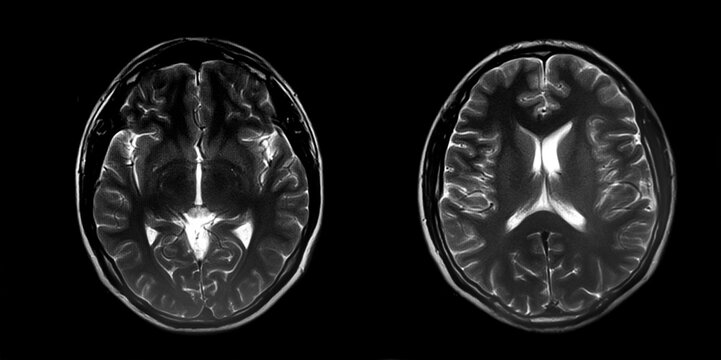 Magnetic resonance image (MRI) of normal brain, panoramic brain tomography