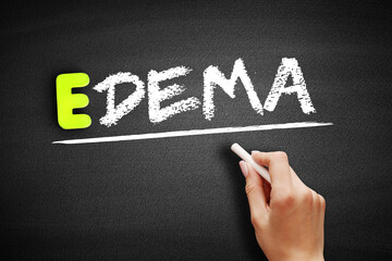 Edema text on blackboard, concept background