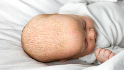 seborrheic dermatitis crusts on the baby's head. child with seborrhea in the hair