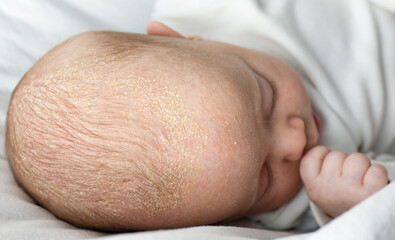 seborrheic dermatitis crusts on the baby's head. child with seborrhea in the hair