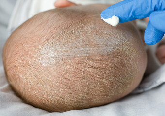 Seborrhea treatment (1of 5). Hand in blue glove puts a piece of cream on baby's seborrheic head