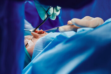 Crop unrecognizable surgeon in protective gloves suturing wound on nose of anonymous patient during rhinoplasty surgery in hospital
