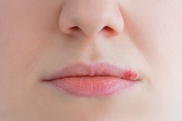 Obraz premium Herpes on the lip of Caucasian woman. Face close-up.