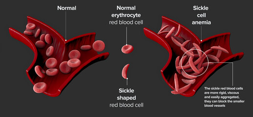 Sickle cell disease is a group of blood disorders. Sickle cell anaemia. It results in an abnormality in the oxygen-carrying protein haemoglobin found in red blood cells. 3d render