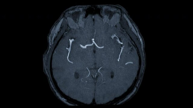 MRA Brain or Magnetic resonance angiography of the brain axial MIP view showing cerebral artery .
