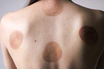 Fototapeta premium A young girl showing a scar from a hijama treatment Islamic medicine