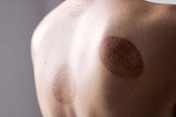 A young girl showing a scar from a hijama treatment Islamic medicine