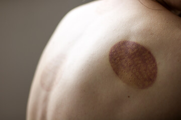 A young girl showing a scar from a hijama treatment Islamic medicine