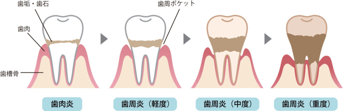 歯周病の過程