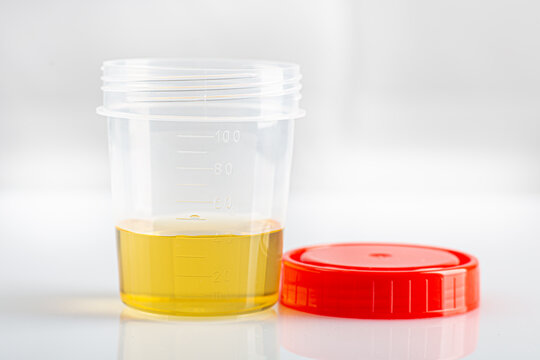 Labotatory container with human urine for medical test