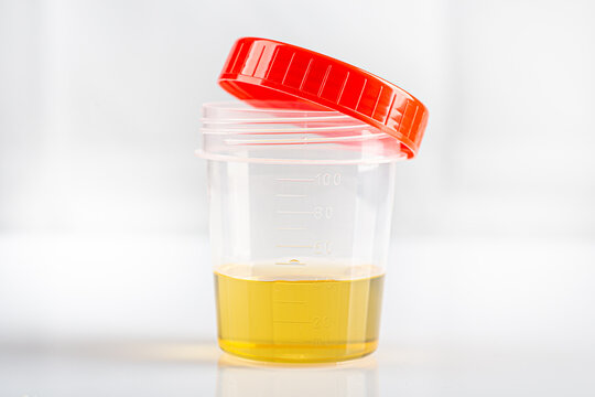 Labotatory container with human urine for medical test