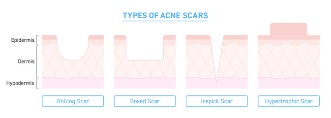 Illustration of types of acne scars