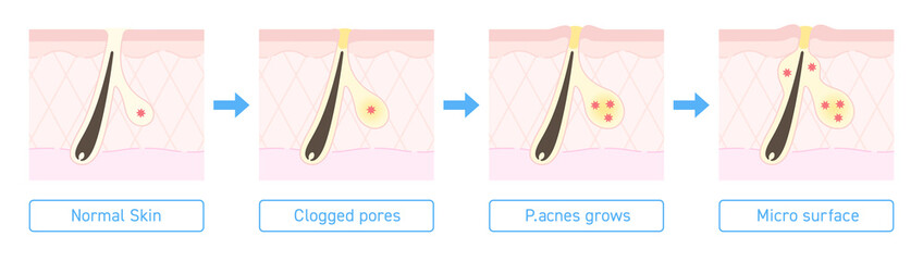 Illustration of acne formation with explanation