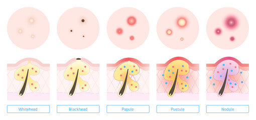 Illustration of types of acne with explanation