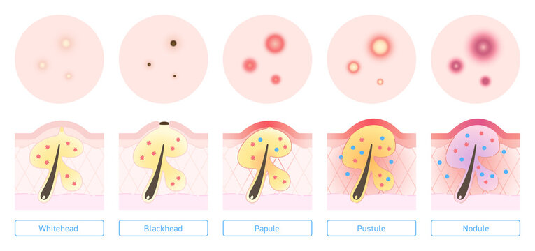 Illustration of types of acne with explanation