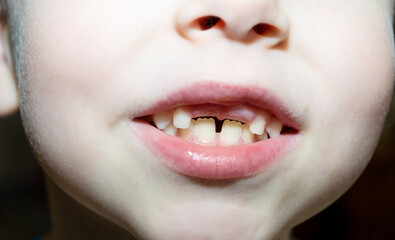 close-up - missing teeth from the upper jaw of a child © Елена 