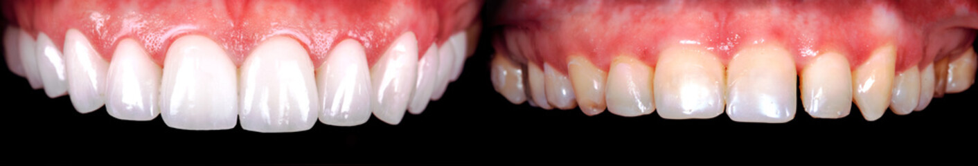 Perfect smile before and after bleaching procedure whitening of zircon arch ceramic prothesis...