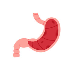 Stomach ulcer isolated vector illustration. Gut disease, cancer symptom, erosion and gastritis design element. 