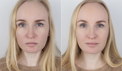 Before and after. A woman examines dry skin on her face. Peeling, coarsening, discomfort, skin sensitivity. Patient at the appointment a dermatologist or cosmetologist. Close-up of pieces of dry skin
