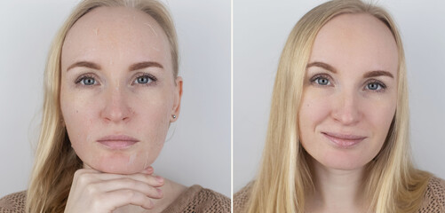 Before and after. A woman examines dry skin on her face. Peeling, coarsening, discomfort, skin sensitivity. Patient at the appointment a dermatologist or cosmetologist. Close-up of pieces of dry skin