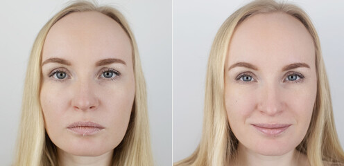Before and after. A woman examines dry skin on her lips. Peeling, coarsening, discomfort, skin...
