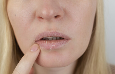 A woman examines dry skin on her lips. Peeling, coarsening, discomfort, skin sensitivity. Patient at the appointment of a dermatologist or cosmetologist. Close-up of pieces of dry skin