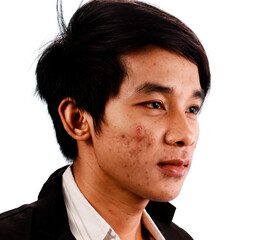 Skin disease and acne
