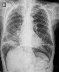 Chest xray images
