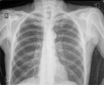 Chest xray images
