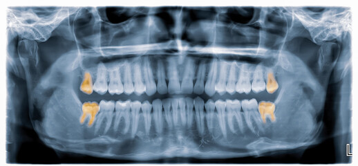 Panoramic dental X-Ray from a mouth with some tooth fillings, and a wisdom tooth crashed into a...