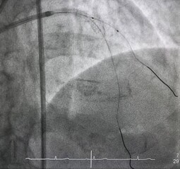 Compliant balloon catheter was at proximal left anterior descending artery (LAD) to diagonal branch...