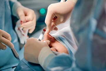 Rhinoplasty men, the surgeon s gloved hands hold the instruments during nose surgery. Doctor in gloves holds a medical instrument during rhinoplasty