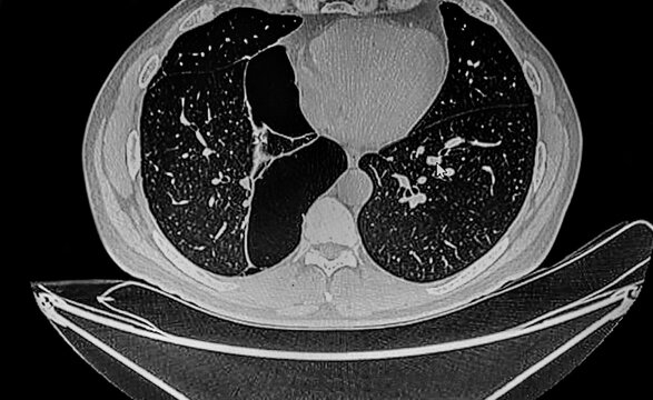 Chest CT SCAN Right Side Showing Bullous Formation In A Patient With Pulmonary Emphysema