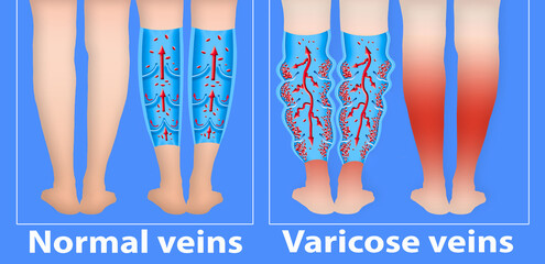 Varicose veins on a female senior legs. The structure of normal and varicose veins.