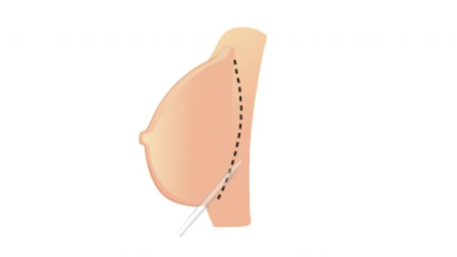 Breast Augmentation. Expanding Breasts. Improved Size, Shape and Volume. Enhanced Bust. medical animation of a woman with breast implants. Breast implants animated motion video 