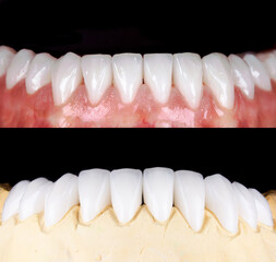 Perfect smile before and after veneers bleach of zircon arch ceramic prothesis Implants crowns....