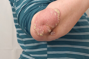 psoriatic plaques on the skin of the elbow joint in a young woman