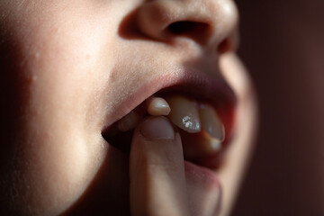 loss of a baby tooth in an eight-year-old child, at the last stage