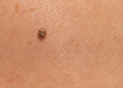 Brown Birthmark (nevus) On Caucasian Man Back Skin 