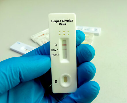 Device of herpes simplex virus (HSV) Virus rapid screening test, showing positive result