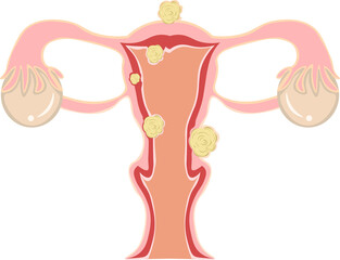 子宮筋腫　イラスト