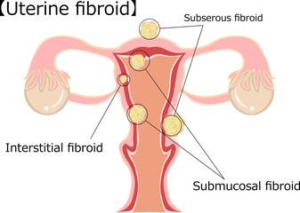 Obraz premium 子宮筋腫 イラスト