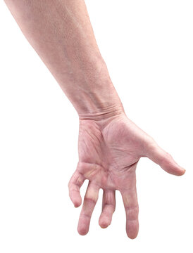 Hand of an man with Dupuytren contracture disease