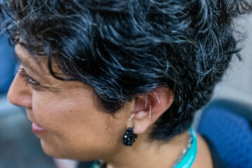 Woman with Acupuncture Needles in Ear