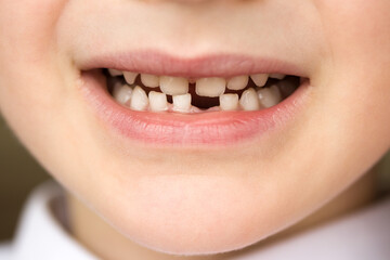 The smile of a five and a half year old boy whose first milk tooth and lower incisor fell out