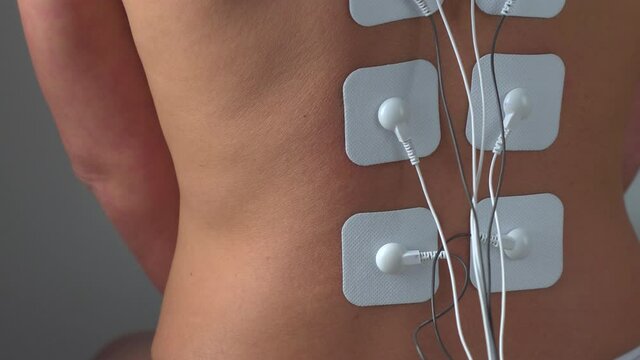 Physiotherapy of the back with TENS electrode pads, external electrical nerve stimulation. Electrodes on the patient's back. TENS electrodes are intended for the treatment and rehabilitation of back 