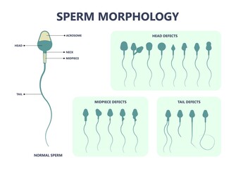 in vitro fertilization IVF semen test sample sperm count type Male biopsy fertility collect Low Poor Zero head anatomy midpiece tail birth control blocked defect abnormal ejaculate vas Non dry